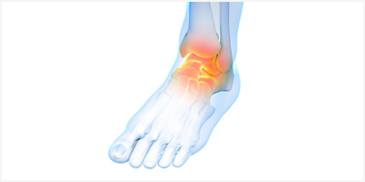 발목염좌 이미지